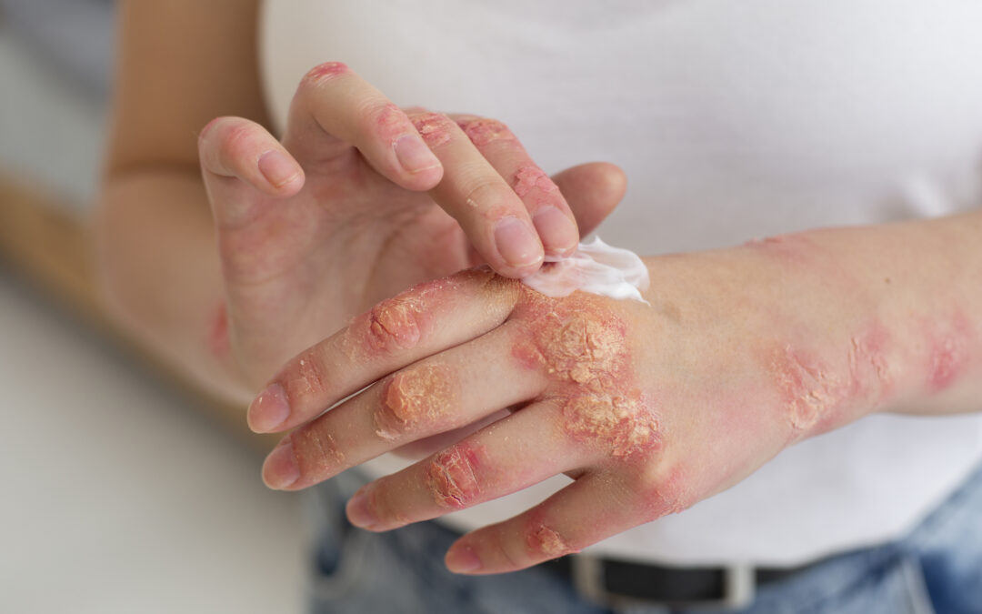 What Is Psoriasis