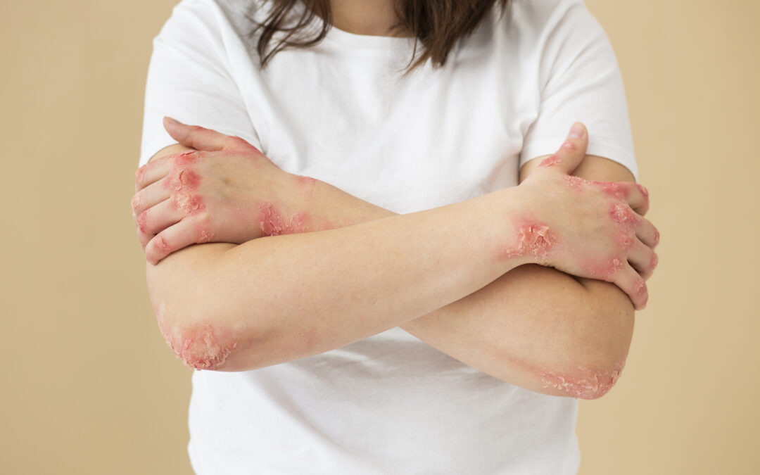 WHAT ARE THE DIFFERENT TYPES OF PSORIASIS?