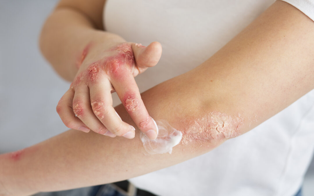 HOW IS PSORIASIS COMMONLY TREATED?